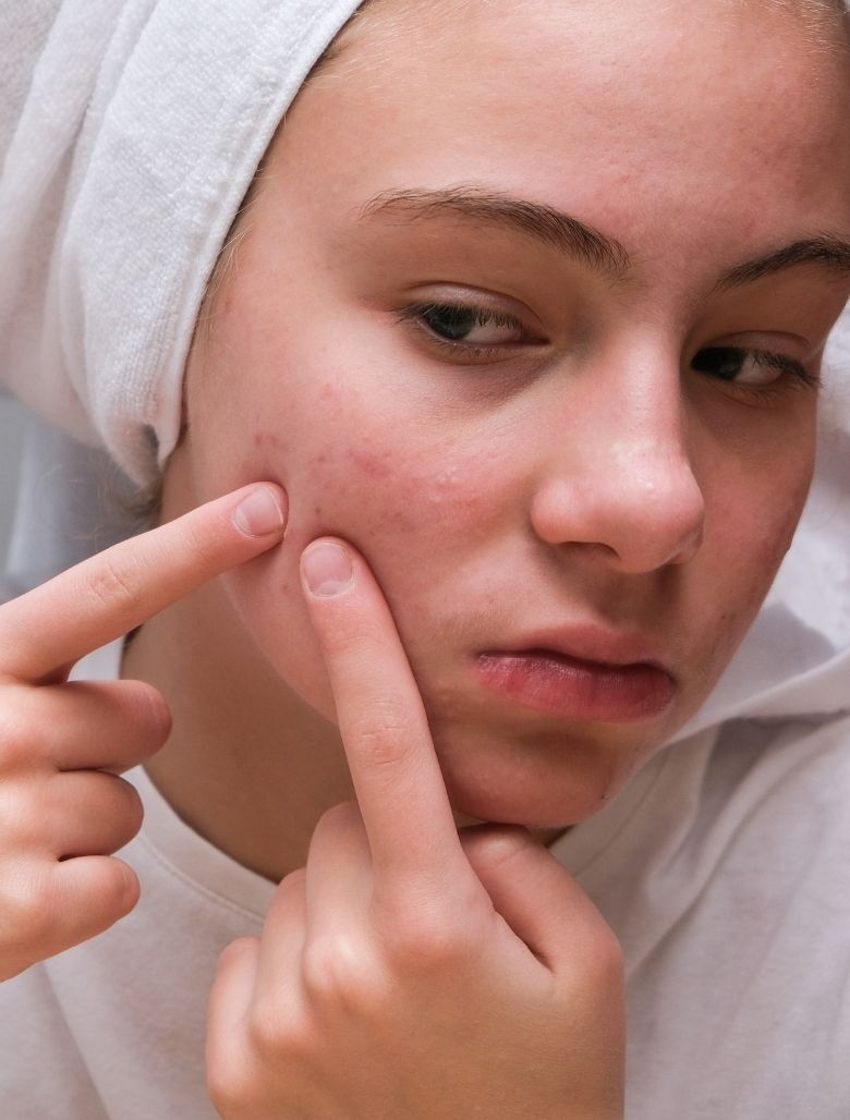 Woman with acne 